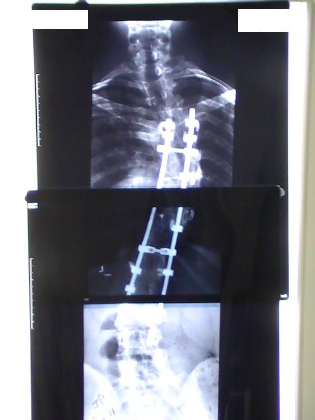 Scoliosis Fusion