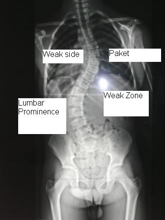 scoliosis_xray_2_frontal_plane